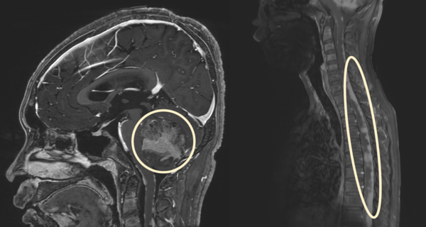 수모세포종 환자의 뇌 및 척수 MRI